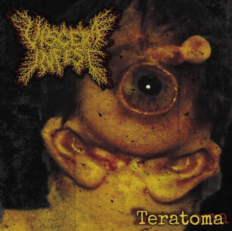 Teratoma/Product Detail/Metal