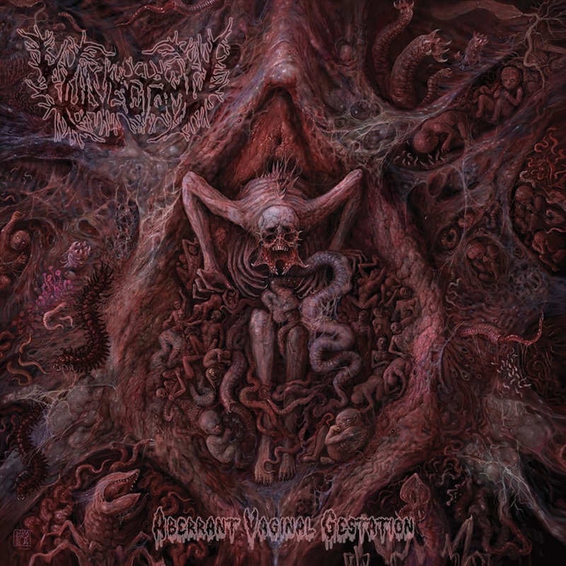 Aberrant Vaginal Gestation/Product Detail/Metal