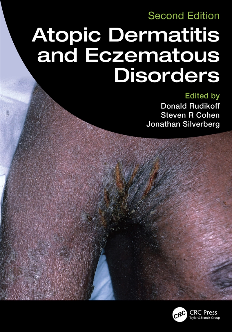 Atopic Dermatitis And Eczematous Disorders/Product Detail/Healthcare