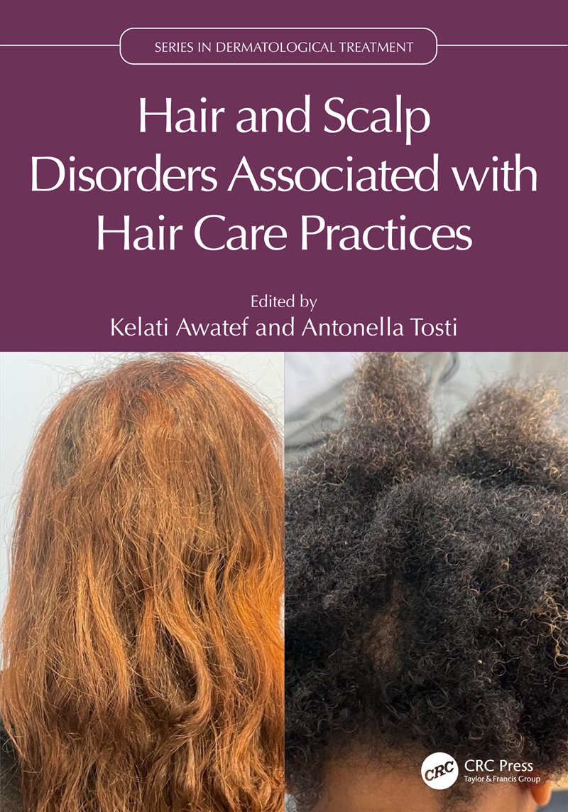 Hair and Scalp Disorders Associated with Hair Care Practices/Product Detail/Healthcare